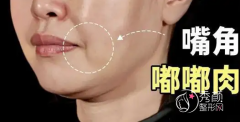 <b>有嘟嘟肉（口角囊袋）又不想吸脂也不想做拉皮怎么解决？</b>