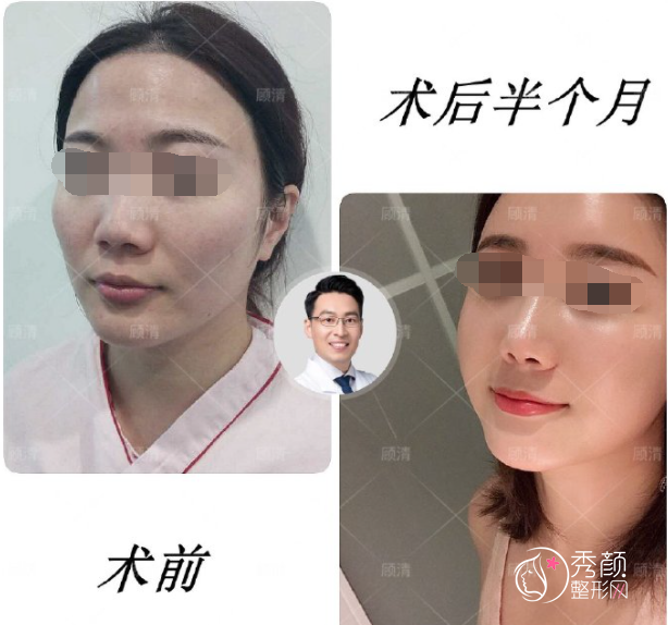 上海伯思立顾清脂肪填充怎么样,有没有失败案例？