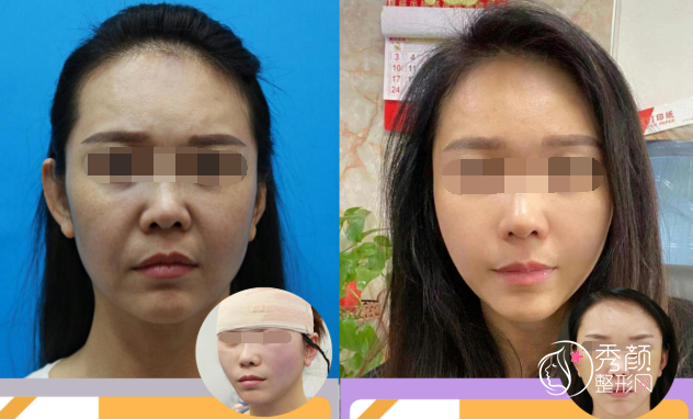 北京加减美穆宝安拉皮做的怎么样，贵不贵？