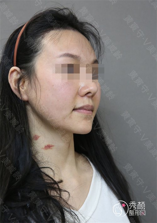 北京加减美黄寅守教授面部拉皮手术案例