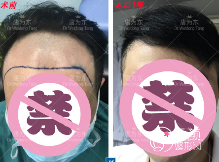 上海伯思立唐为东植发怎么样，附植发案例分享。