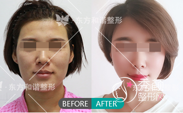 北京东方和谐王自谦脂肪填充怎么样，附脂肪填充案例