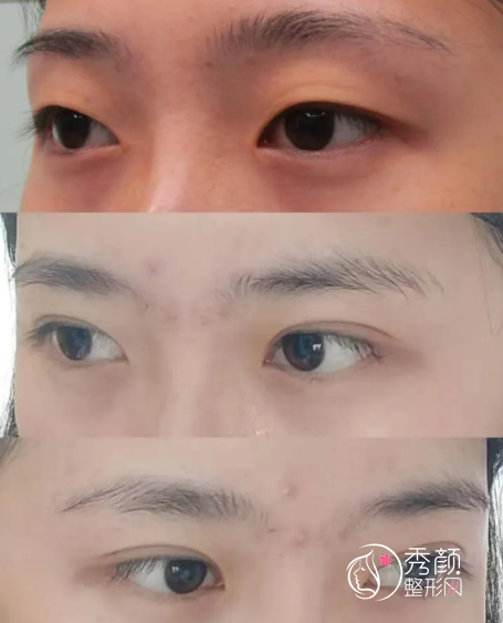 成都素美杨迪做双眼皮怎么样，附杨迪双眼皮案例