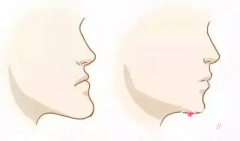 上海九院做正颌手术一般需要多少钱，上海九院正颌正畸流程