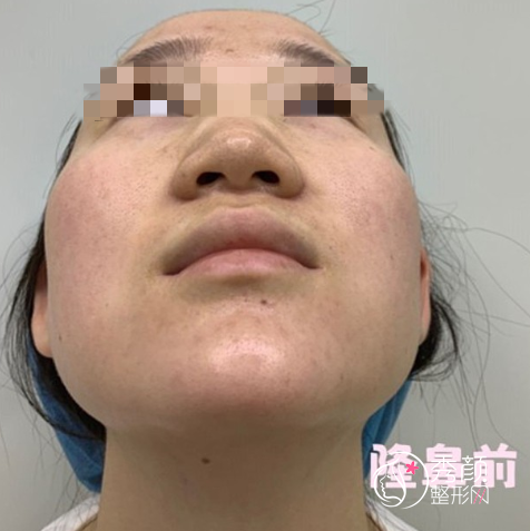 西安画美杨万忠隆鼻怎么样，有没有失败案例？