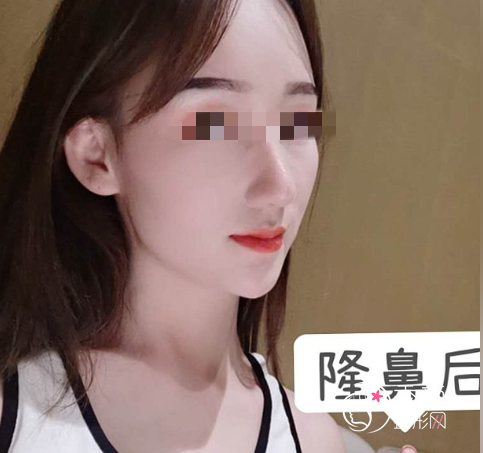西安画美杨万忠隆鼻怎么样，有没有失败案例？