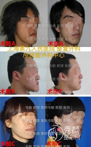 上海九院韦敏做正颌手术怎么样，有没有失败案例？