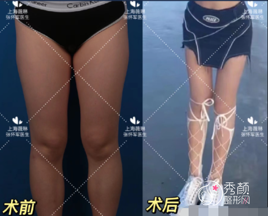 上海薇琳张怀军吸脂怎么样，有没有失败案例？