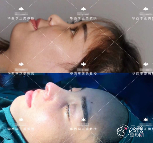 成都华西医院李正勇隆鼻怎么样，附隆鼻案例图