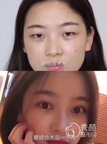 重庆华美李富强做双眼皮怎么样，有没有失败案例？