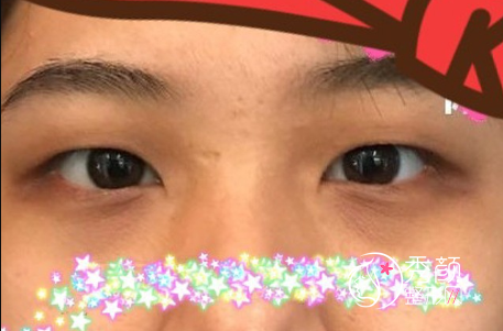 重庆艺星王方鹏做双眼皮怎么样，有没有失败案例？