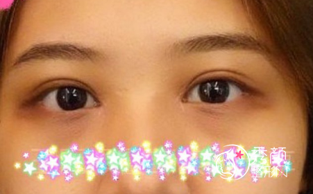 重庆艺星王方鹏做双眼皮怎么样，有没有失败案例？