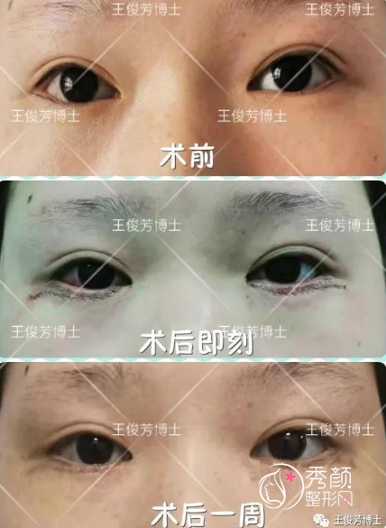 上海九院王俊芳双眼皮修复怎么样，有没有失败案例？