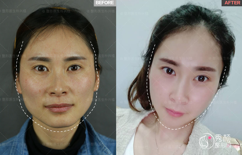 上海首尔丽格朴兴植磨骨怎么样，附颧骨内推+下颌角截骨案例