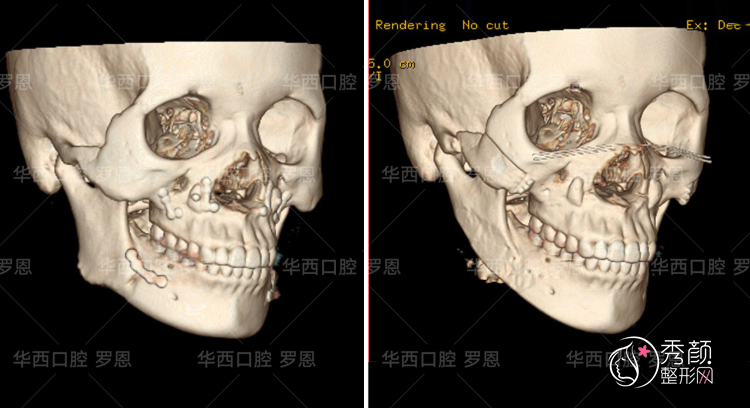成都罗恩磨骨有失败的吗,罗恩磨骨保守吗？