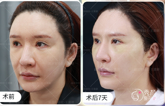 北京丰联丽格王冀耕做拉皮好吗，有没有失败案例？