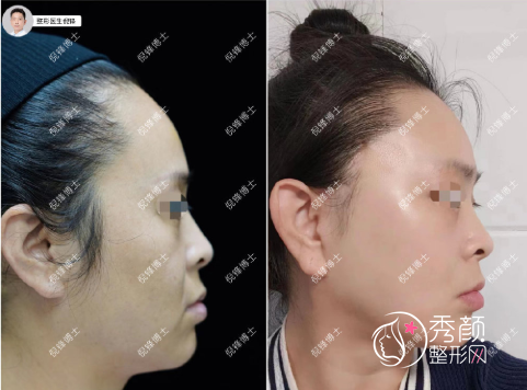 上海倪锋拉皮手术做得怎么样，有没有失败案例？