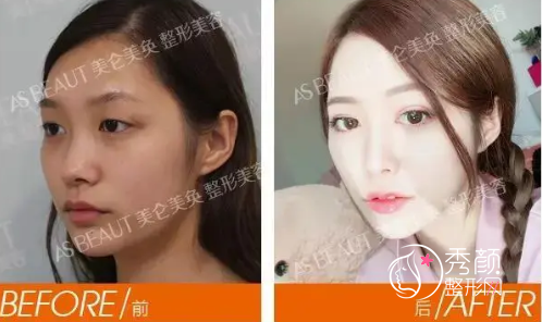重庆美仑美奂董开云双眼皮做得怎么样，附双眼皮真实案例分享