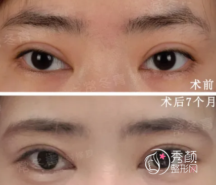 北京常冬青修复双眼皮怎么样,附常冬青双眼皮修复案例