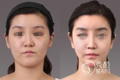北京八大处颧骨内推哪个医生做得好？口碑审美技术对比