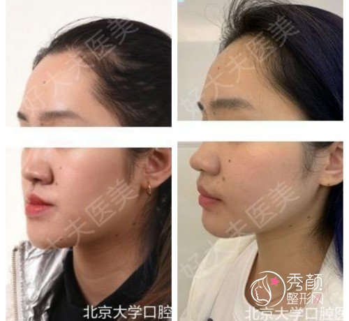 北京大学口腔医院刘筱菁正颌手术怎么样，附刘筱菁正颌手术案例