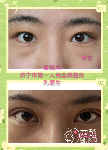 济宁市第一人民医院孔祥红双眼皮修复怎么样，附双眼皮案例