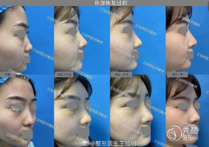 重庆当代王旭明做鼻子怎么样，附王旭明隆鼻案例恢复过程