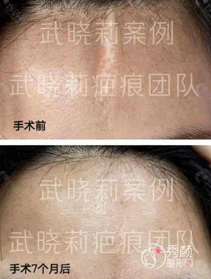 上海九院疤痕修复多少钱，哪个医生祛疤效果好？