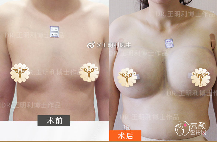 北京玉之光王明利隆胸怎么样，附王明利自体脂肪隆胸案例
