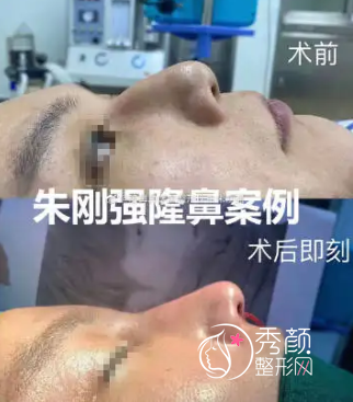 福州鼓楼爱美尔朱刚强鼻子做得怎么样，附朱刚强隆鼻案例