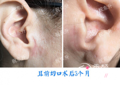 祝东升做拉皮手术口碑怎么样，附祝东升面部提升案例