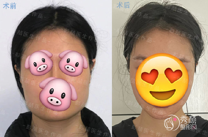 北京大学人民医院彭喆磨骨怎么样,附彭喆颧骨内推下颌角案例