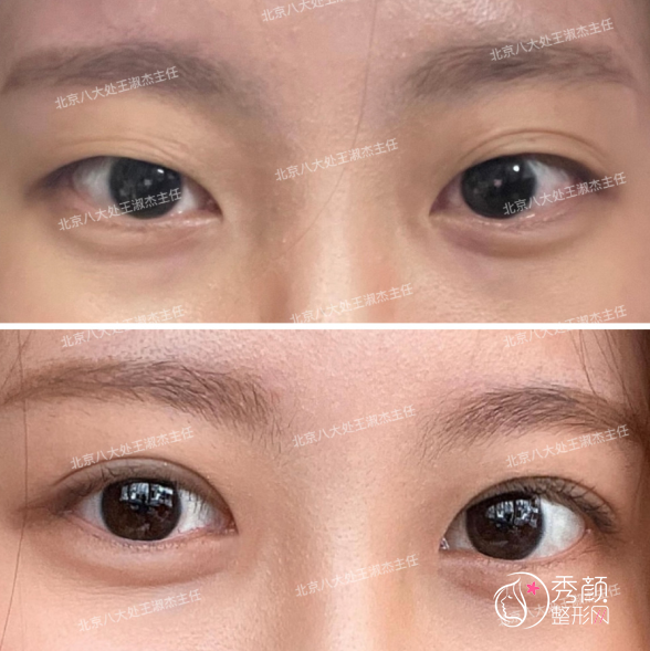 北京八大处王淑杰做双眼皮怎么样，附王淑杰双眼皮案例