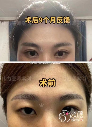 湖南郴州尹伟力修复双眼皮怎么样，附双眼皮修复案例