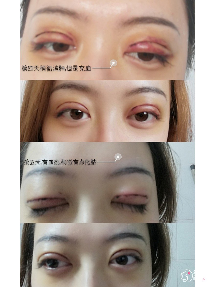 沈阳名流王莉莉做双眼皮怎么样,附王莉莉双眼皮案例分享