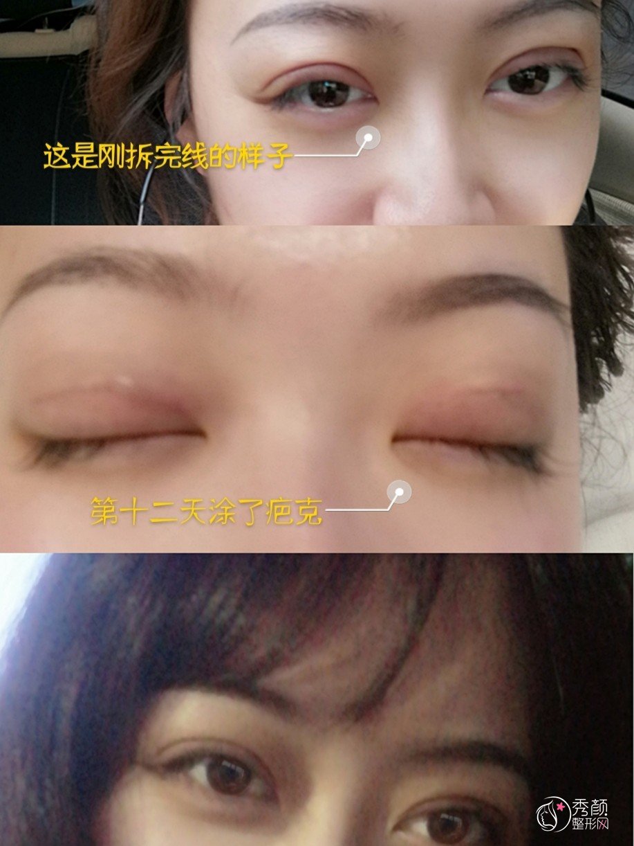 沈阳名流王莉莉做双眼皮怎么样,附王莉莉双眼皮案例分享