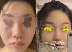 沈阳名流王松和王旭哪个做鼻子更好?口碑技术案例对比