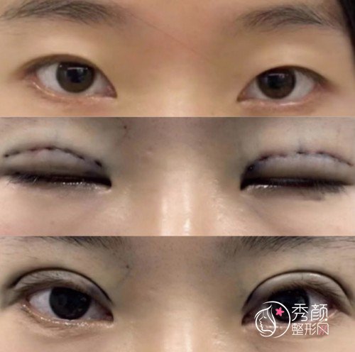 沈阳童颜医疗美容韩忠辉做双眼皮怎么样，附韩忠辉双眼皮案例