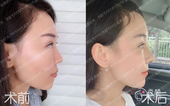 青岛伊美尔刘长发隆鼻怎么样，附隆鼻真实案例对比