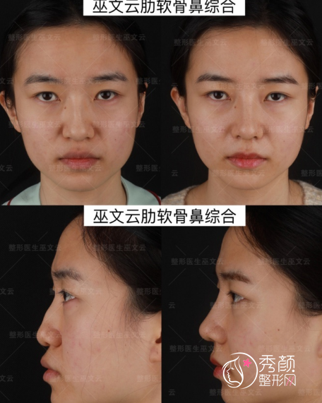 北京米扬丽格巫文云隆鼻怎么样，附肋软骨案例