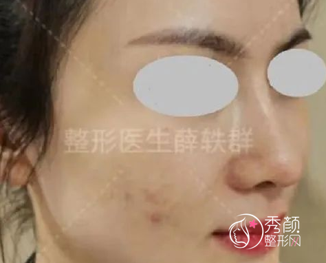 北京丽合医疗美容薛轶群隆鼻怎么样，附案例分享