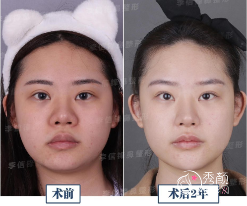 深圳李信锋鼻修复真的做得好吗，附李信锋隆鼻案例