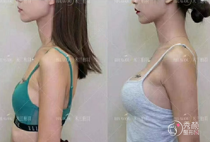 成都米兰柏羽魏家宾隆胸技术怎么样|附隆胸案例