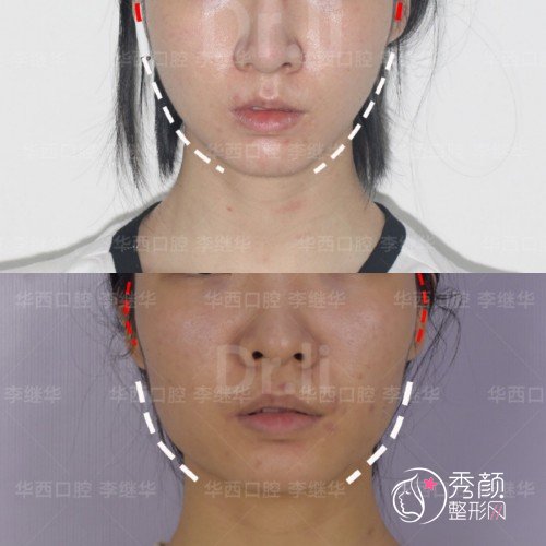 成都友谊医院李继华磨骨怎么样，附李继华颧骨内推下颌角案例