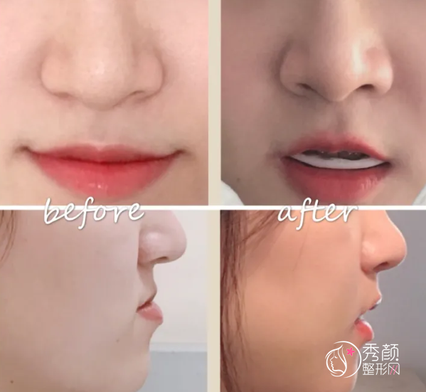 四川华西口腔李继华正颌手术怎么样，附正颌手术案例