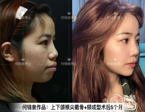 广州广大何锦泉做正颌手术怎么样,附正颌手术颏成型案例