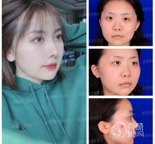 深圳陈桂飞做鼻子怎么样,附陈桂飞隆鼻案例