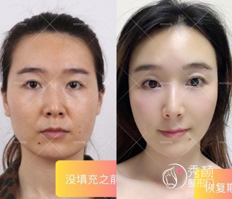 上海华美李健全脸脂肪填充怎么样，附脂肪填充案例