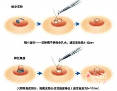 北京协和医院做缩胸手术怎么样，大概需要多少钱？