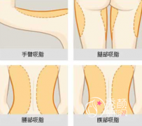2022北京抽脂费用抽脂价格一览表